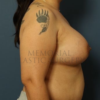 A side view after photo of patient 125 that underwent Breast Augmentation procedures at Memorial Plastic Surgery