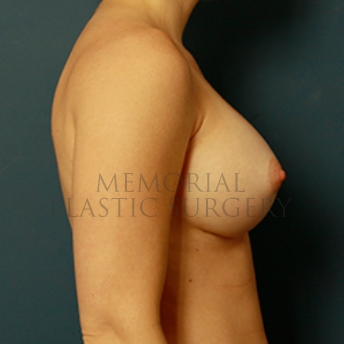A side view after photo of patient 372 that underwent Breast Augmentation procedures at Memorial Plastic Surgery