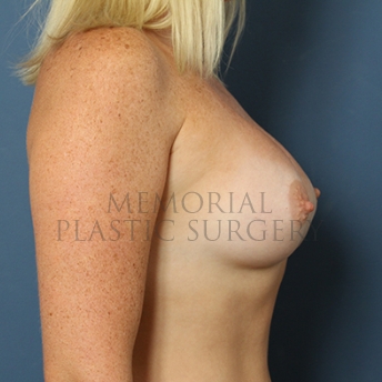 A side view after photo of patient 289 that underwent Breast Augmentation procedures at Memorial Plastic Surgery