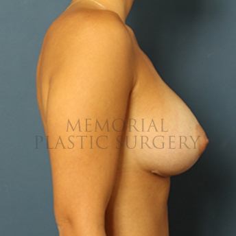 A side view after photo of patient 402 that underwent Breast Augmentation procedures at Memorial Plastic Surgery