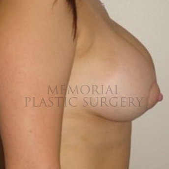 A side view after photo of patient 169 that underwent Breast Augmentation procedures at Memorial Plastic Surgery