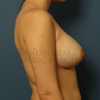 A side view after photo of patient 128 that underwent Breast Augmentation procedures at Memorial Plastic Surgery
