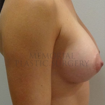 A side view after photo of patient 184 that underwent Breast Augmentation procedures at Memorial Plastic Surgery