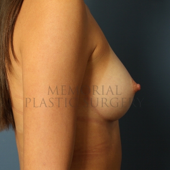 A side view after photo of patient 415 that underwent Breast Augmentation procedures at Memorial Plastic Surgery
