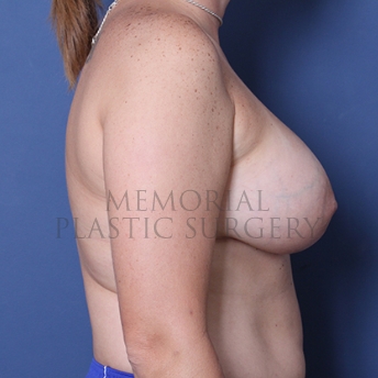 A side view after photo of patient 286 that underwent Breast Augmentation procedures at Memorial Plastic Surgery