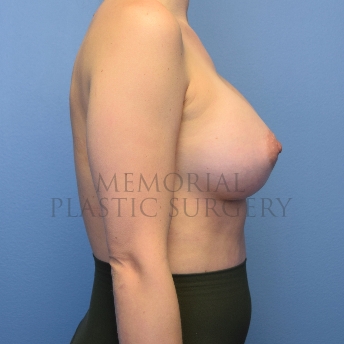 A side view after photo of patient 4101 that underwent Breast Augmentation procedures at Memorial Plastic Surgery