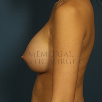 A side view after photo of patient 398 that underwent Breast Augmentation procedures at Memorial Plastic Surgery