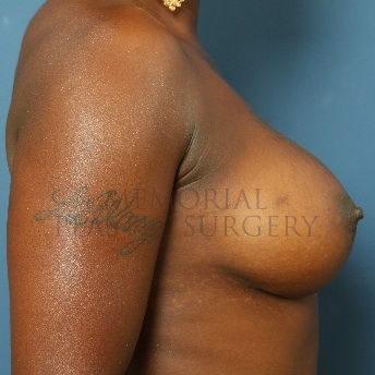 A side view after photo of patient 77 that underwent Breast Augmentation procedures at Memorial Plastic Surgery