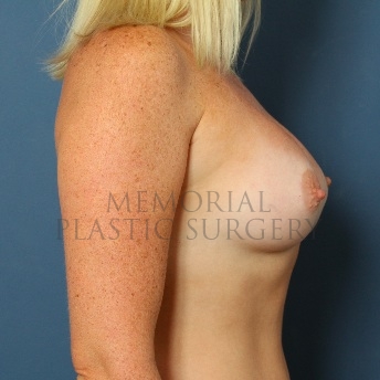A side view after photo of patient 61 that underwent Breast Augmentation procedures at Memorial Plastic Surgery