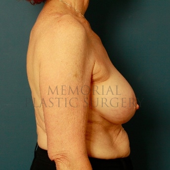 A side view after photo of patient 72 that underwent Breast Augmentation procedures at Memorial Plastic Surgery
