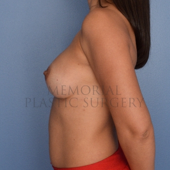 A side view after photo of patient 708 that underwent Breast Augmentation procedures at Memorial Plastic Surgery