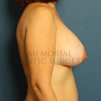 A side view after photo of patient 140 that underwent Breast Augmentation procedures at Memorial Plastic Surgery