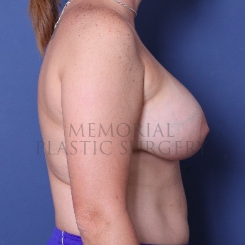A side view after photo of patient 60 that underwent Breast Augmentation procedures at Memorial Plastic Surgery