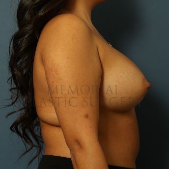 A side view after photo of patient 157 that underwent Breast Augmentation procedures at Memorial Plastic Surgery