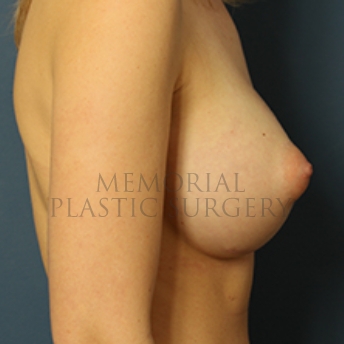 A side view after photo of patient 378 that underwent Breast Augmentation procedures at Memorial Plastic Surgery