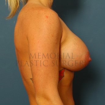 A side view after photo of patient 75 that underwent Breast Augmentation procedures at Memorial Plastic Surgery