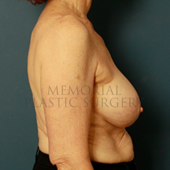 A side view after photo of patient 332 that underwent Breast Augmentation procedures at Memorial Plastic Surgery