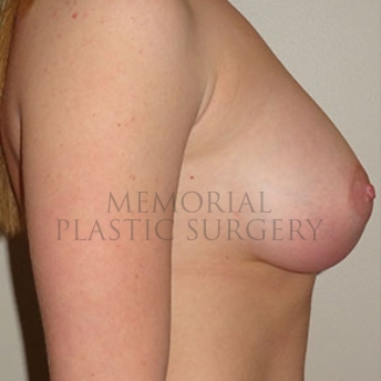 A side view after photo of patient 171 that underwent Breast Augmentation procedures at Memorial Plastic Surgery