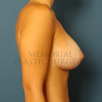 A side view after photo of patient 101 that underwent Breast Augmentation procedures at Memorial Plastic Surgery