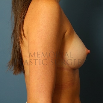 A side view after photo of patient 110 that underwent Breast Augmentation procedures at Memorial Plastic Surgery