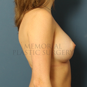 A side view after photo of patient 385 that underwent Breast Augmentation procedures at Memorial Plastic Surgery