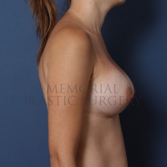 A side view after photo of patient 462 that underwent Breast Augmentation procedures at Memorial Plastic Surgery