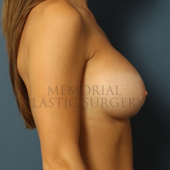A side view after photo of patient 403 that underwent Breast Augmentation procedures at Memorial Plastic Surgery