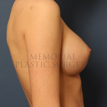 A side view after photo of patient 395 that underwent Breast Augmentation procedures at Memorial Plastic Surgery