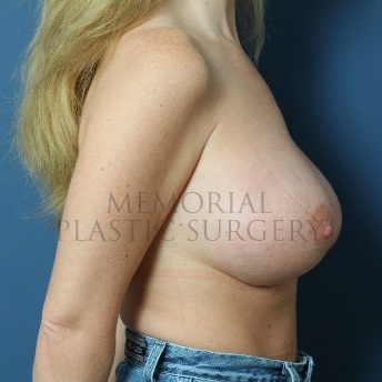 A side view after photo of patient 97 that underwent Breast Augmentation procedures at Memorial Plastic Surgery