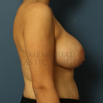 A side view after photo of patient 254 that underwent Breast Augmentation procedures at Memorial Plastic Surgery