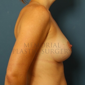 A side view after photo of patient 59 that underwent Breast Augmentation procedures at Memorial Plastic Surgery