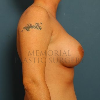 A side view after photo of patient 165 that underwent Breast Augmentation procedures at Memorial Plastic Surgery