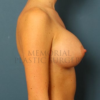 A side view after photo of patient 136 that underwent Breast Augmentation procedures at Memorial Plastic Surgery