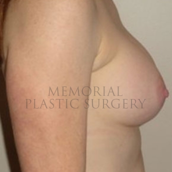 A side view after photo of patient 187 that underwent Breast Augmentation procedures at Memorial Plastic Surgery