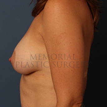 A side view after photo of patient 357 that underwent Breast Augmentation procedures at Memorial Plastic Surgery