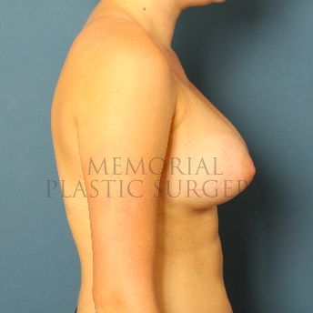 A side view after photo of patient 107 that underwent Breast Augmentation procedures at Memorial Plastic Surgery