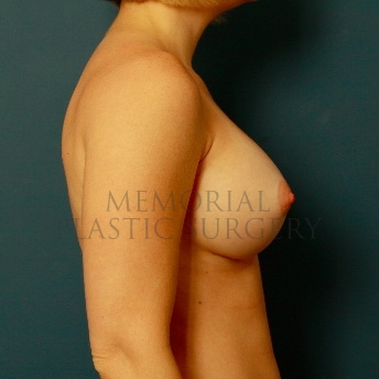 A side view after photo of patient 89 that underwent Breast Augmentation procedures at Memorial Plastic Surgery