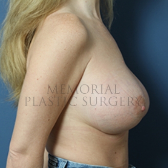 A side view after photo of patient 391 that underwent Breast Augmentation procedures at Memorial Plastic Surgery