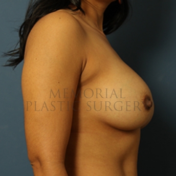 A side view after photo of patient 369 that underwent Breast Augmentation procedures at Memorial Plastic Surgery