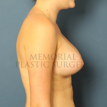 A side view after photo of patient 468 that underwent Breast Augmentation procedures at Memorial Plastic Surgery