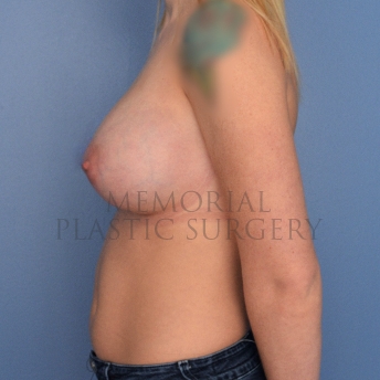 A side view after photo of patient 2520 that underwent Breast Augmentation procedures at Memorial Plastic Surgery