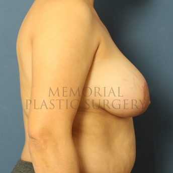 A side view after photo of patient 464 that underwent Breast Augmentation procedures at Memorial Plastic Surgery
