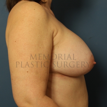 A side view after photo of patient 457 that underwent Breast Augmentation procedures at Memorial Plastic Surgery
