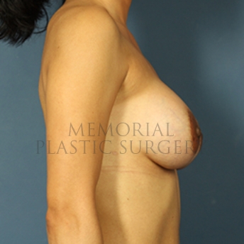 A side view after photo of patient 336 that underwent Breast Augmentation procedures at Memorial Plastic Surgery