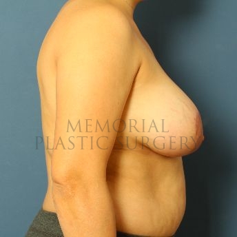 A side view after photo of patient 154 that underwent Breast Augmentation procedures at Memorial Plastic Surgery