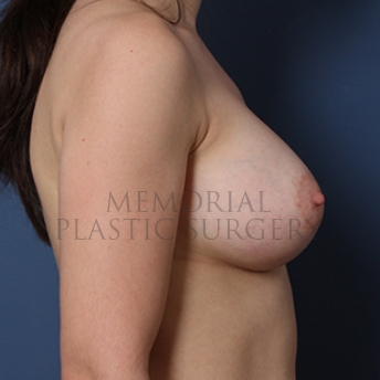 A side view after photo of patient 302 that underwent Breast Augmentation procedures at Memorial Plastic Surgery