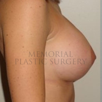 A side view after photo of patient 189 that underwent Breast Augmentation procedures at Memorial Plastic Surgery
