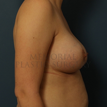 A side view after photo of patient 350 that underwent Breast Augmentation procedures at Memorial Plastic Surgery