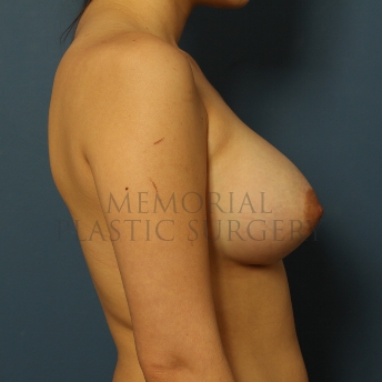 A side view after photo of patient 413 that underwent Breast Augmentation procedures at Memorial Plastic Surgery