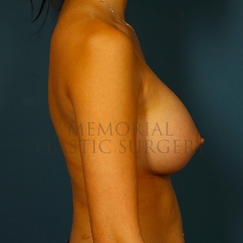 A side view after photo of patient 100 that underwent Breast Augmentation procedures at Memorial Plastic Surgery